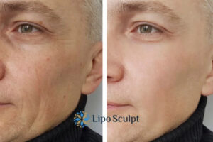 How to Fight Aging Symptoms 3 Fight Aging Symptoms Glossop With HIFU and Morpheus8 Today!