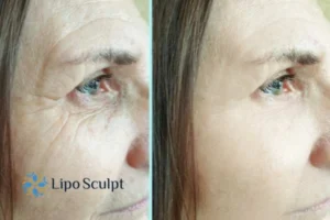 How to Fight Aging Symptoms 2 Do you want to Fight Aging Symptoms Glossop? Contact Lipo Sculpt today!
