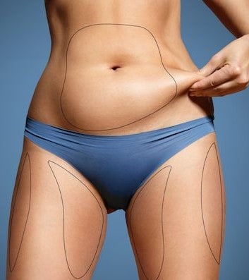 Cryolipolysis