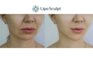 Explaining Total Skin Tightening Treatment And What It Can Do For You 2 Do you want to boost your self confidence? Give Morpheus8 Glossop a try today!