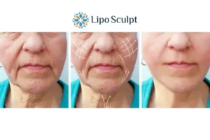 Explaining Total Skin Tightening Treatment And What It Can Do For You 3 Boost your confidence with Morpheus8 Glossop call our team today!