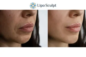 Explaining Total Skin Tightening Treatment And What It Can Do For You 4 Morpheus8 Glossop the best results - call our team today!