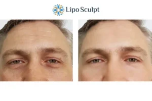 Explaining Total Skin Tightening Treatment And What It Can Do For You 6 Morpheus8 Glossop book in today to find out more!