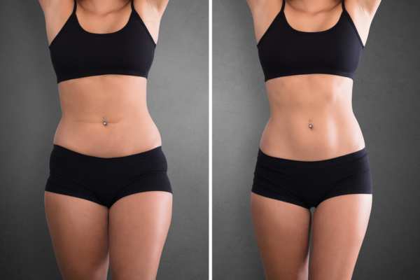 DIASTASIS RECTI results
