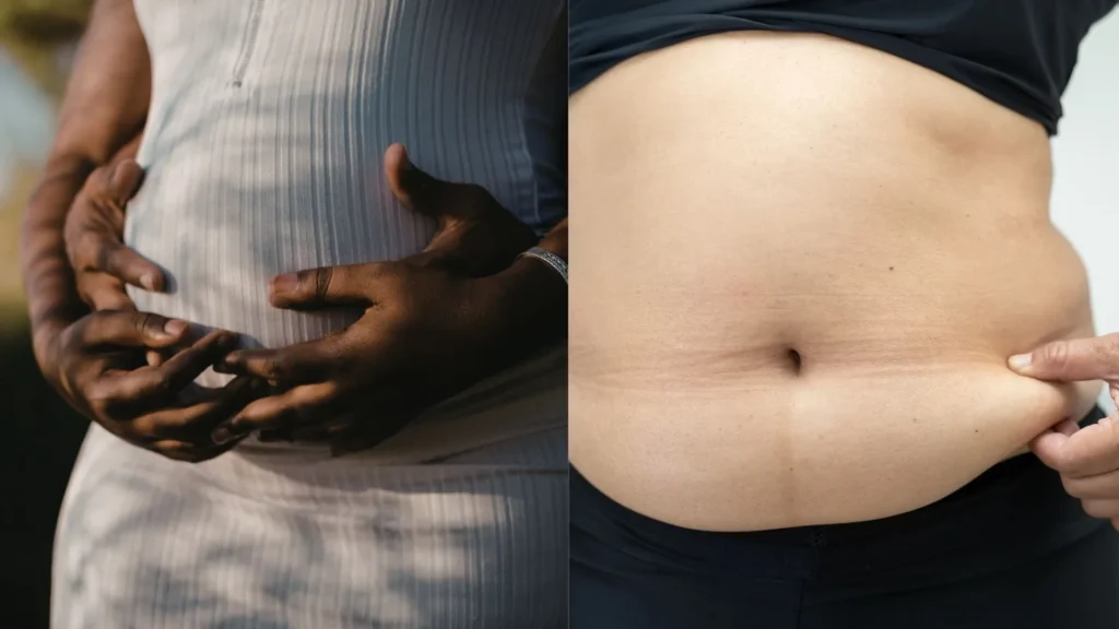 Do Belly Bands Help Prevent Diastasis Recti? 2 When a Belly Band Genuinely Makes Sense in Case of Diastasis Recti